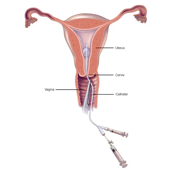 Histerosalpingografia